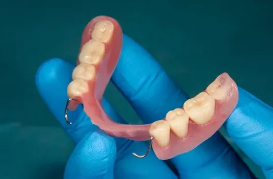 Prótese Parcial Removível